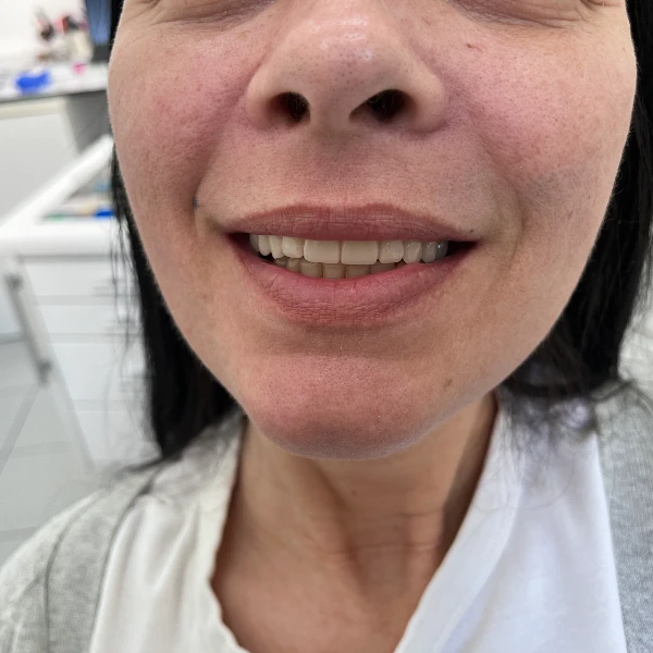 Model zubnog implantata sa krunicom